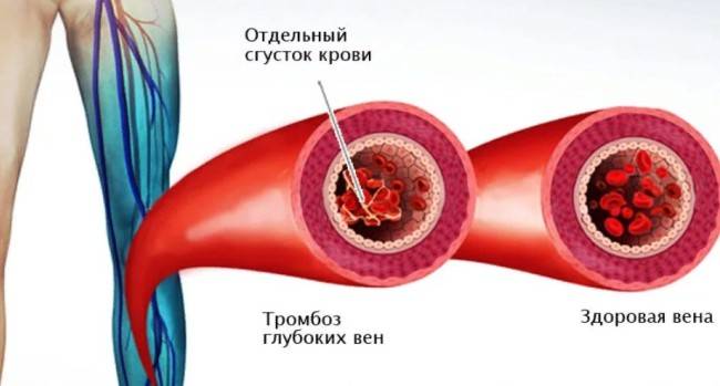 Ознаки тромбів у судинах
