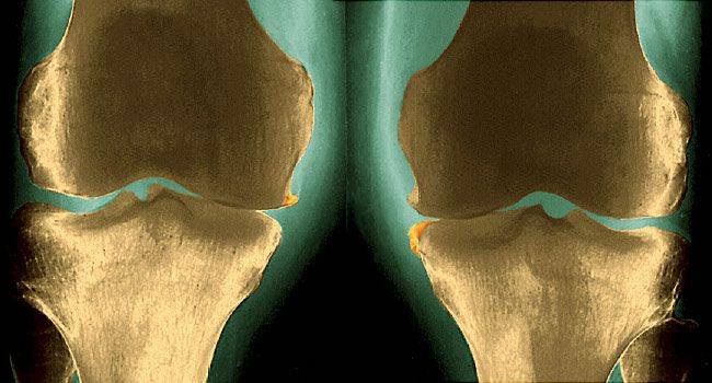 5 побочных эффектов ревматоидного артрита, о которых вы должны знать