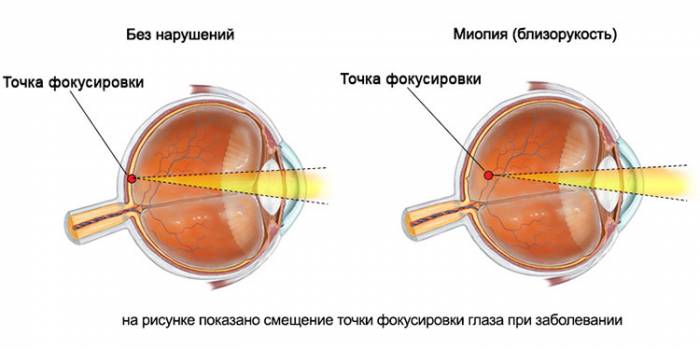 Синдром компьютерного зрения