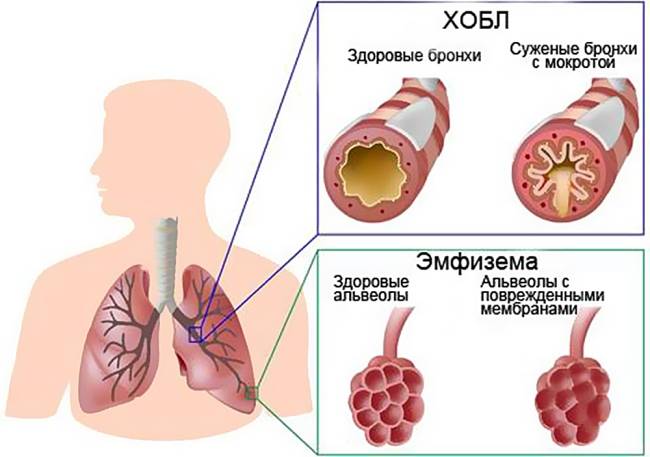 Причини та лікування хронічної обструктивної хвороби легень