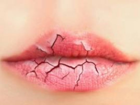 Полезные советы, как избавиться от потрескавшихся губ