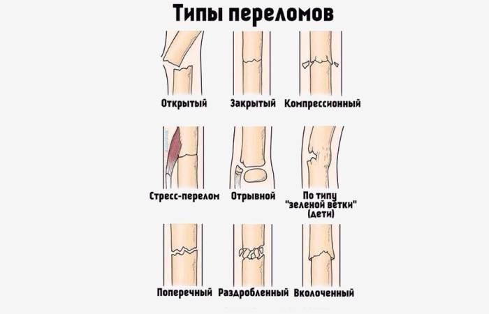 Типы переломов