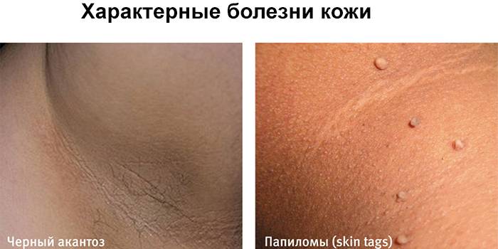 Характерные проявления на коже