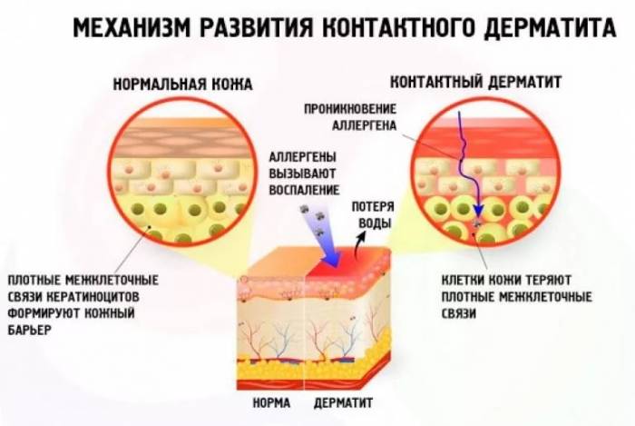 Механизм развития контактного дерматита