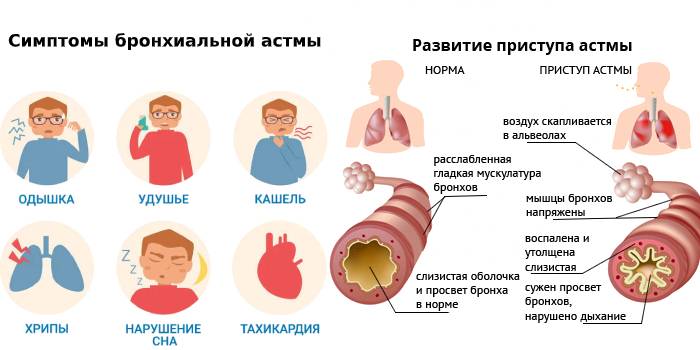 Симптомы и развитие приступа бронхиальной астмы