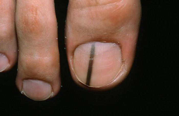 Субунгальная меланома на ногте большого пальца ноги