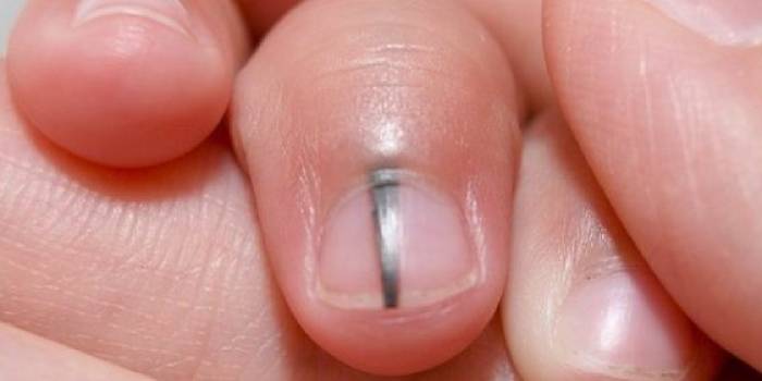 Признак меланомы на ногте