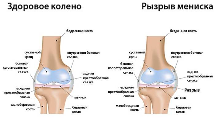 Здоровое колено и разрыв мениска 