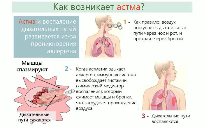 Как возникает астма