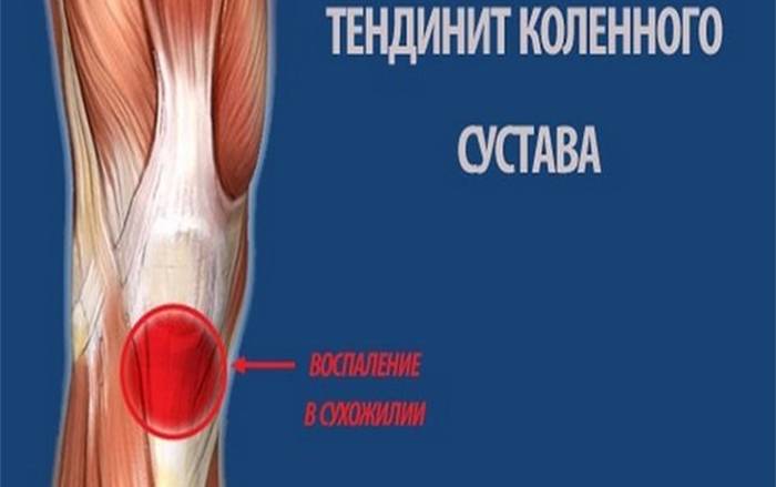 Воспаление коленных связок лечение