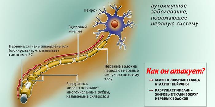 Механизм развития рассеянного склероза