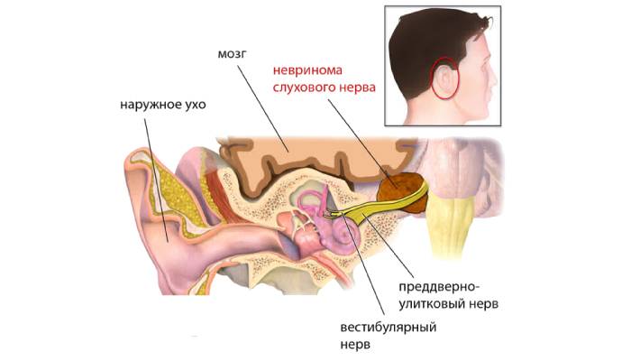 Опухоль черепного нерва на схеме