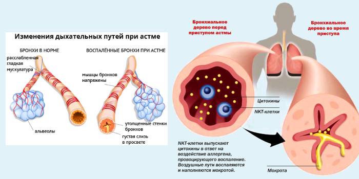 Приступ астмы на схеме
