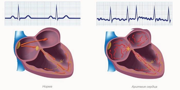 Сердцебиение при аритмии
