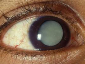 Симптомы глаукомы, которые необходимо знать