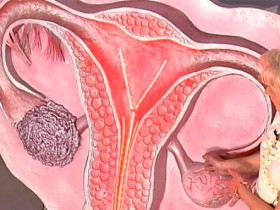 6 признаков рака яичников у женщин
