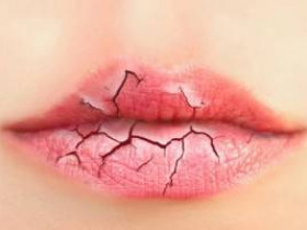 7 причин потрескавшихся губ и способы лечения