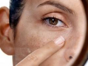 6 натуральных средств для удаления темных пятен на лице