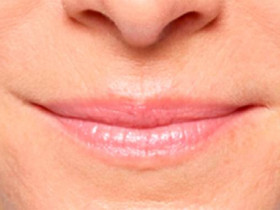 6 эффективных народных средств от морщин вокруг рта