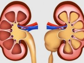 Что такое гидронефроз одной почки