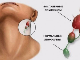 Лимфоузлы за ухом схема увеличен лечение