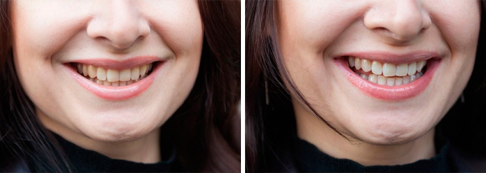 Фото до и после отбеливания зубов