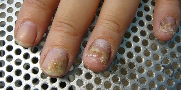 Ногти на руке пораженные грибком