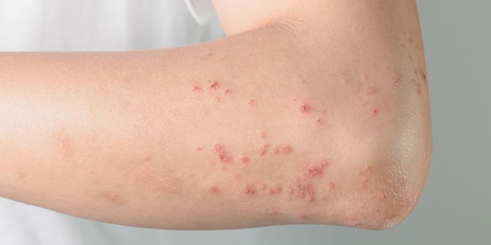 Аллергическая сыпь на коже руки