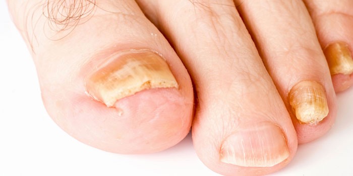 Пораженные грибком ногти на ногах
