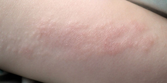 Аллергические высыпания на коже