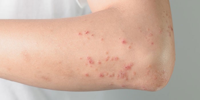 Проявления аллергии на коже