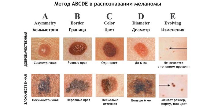 Метод ABCDE в распознавании меланомы