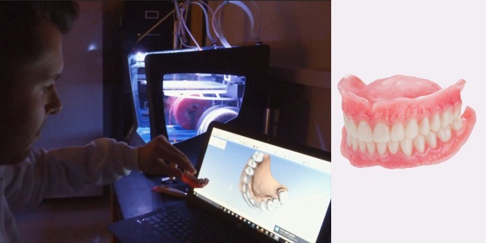 Протез с 3D-печатью