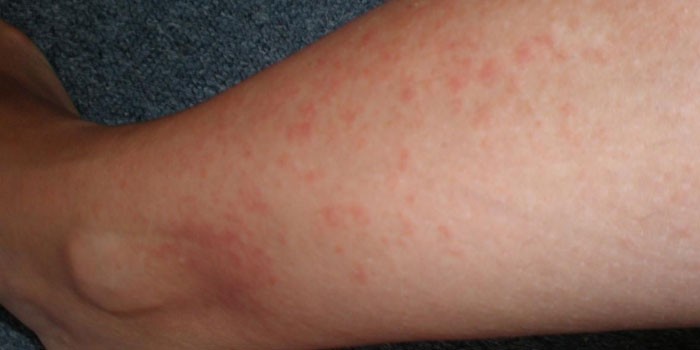 Аллергические реакции на коже ноги