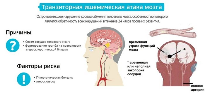 Транзиторная ишемическая атака мозга