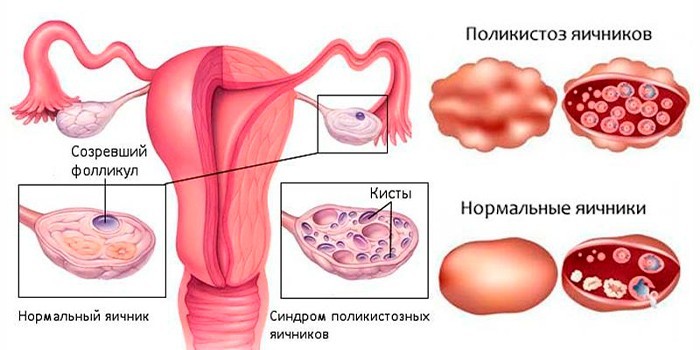 Синдром поликистозных яичников